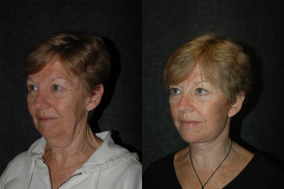 Deep Plane Facelift Before and After