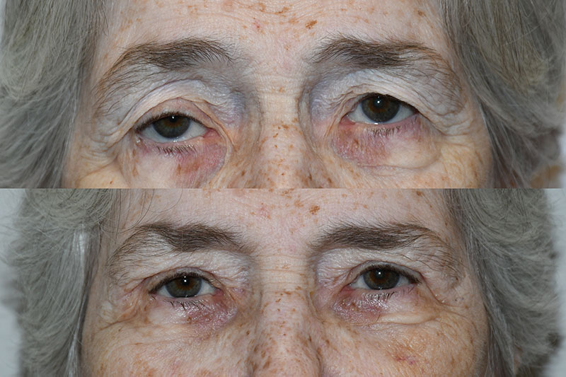 Blepharoplasty Before and After Patient Photos