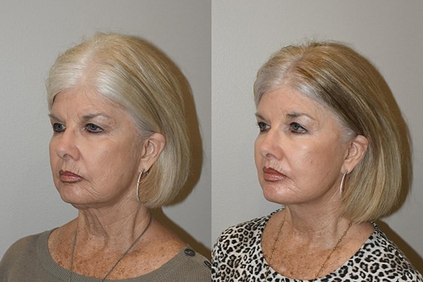Best Necklift Before and After Photos