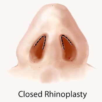 Closed Rhinoplasty Diagram
