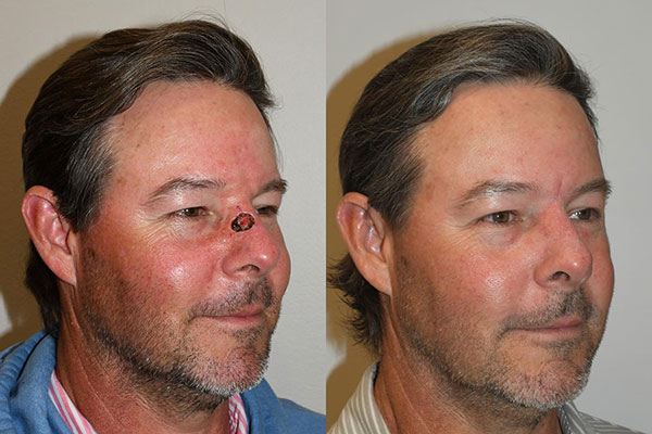 Best Mohs Facial Reconstructive Before After