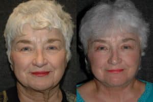 blepharoplasty patient before and after photos