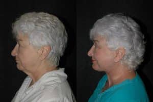 blepharoplasty patient before and after photos