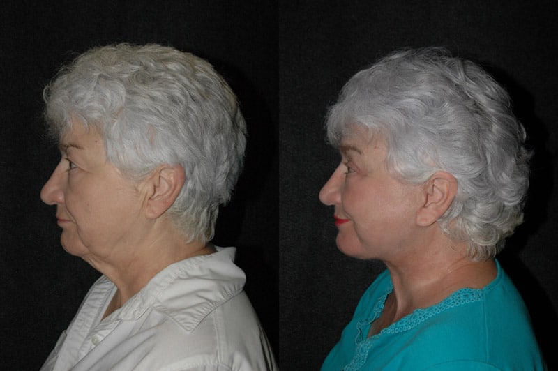 Deep Plane Facelift Before and After