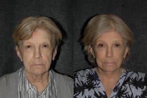 Eye Lift - Patient - Before and After