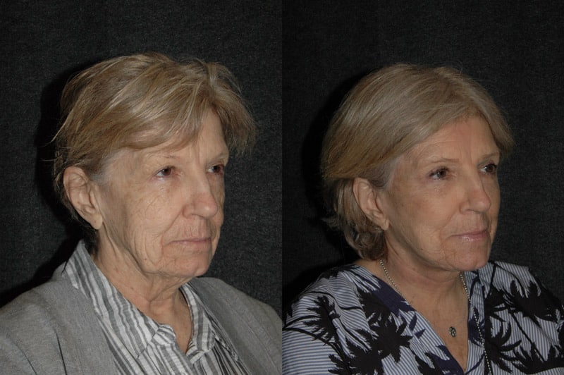 Deep Plane Facelift Before and After