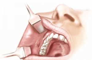 buccal fat removal incision