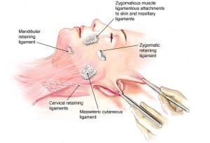 deep plane facelift ligament