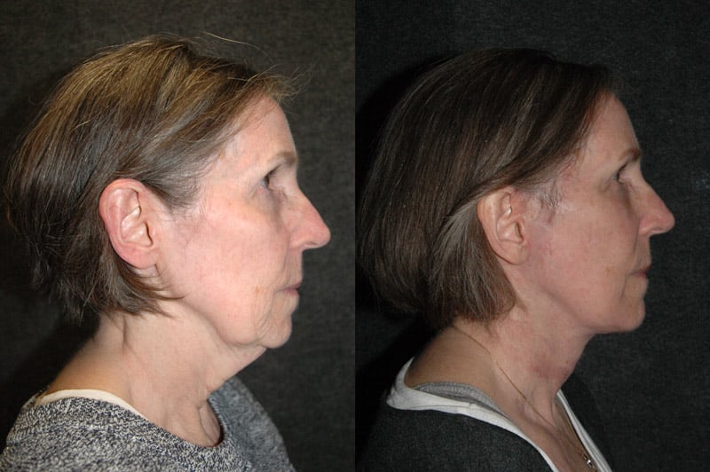 Deep Plane Facelift Before and After
