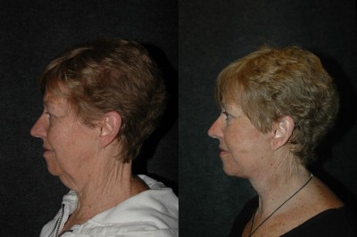 Deep Plane Facelift Before and After