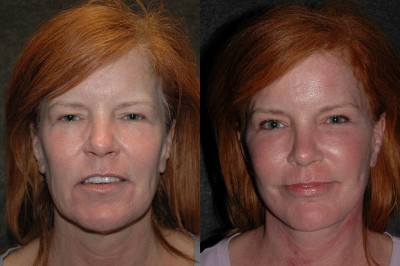 Deep Plane Facelift Before and After