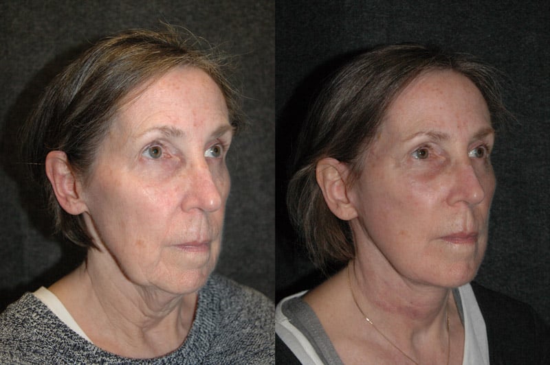 Deep Plane Facelift Before and After