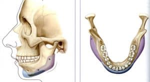 jaw implants