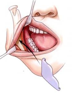 jaw implants