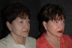 revision facelift - before and after