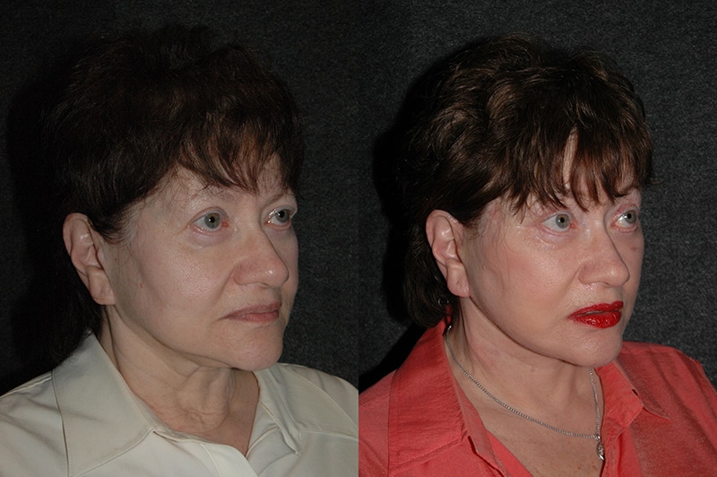 Revision Facelift Patient Photos