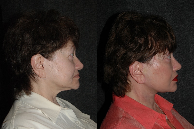 Revision Facelift Patient Photos Side View