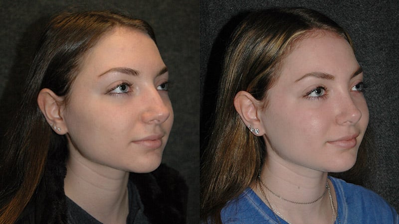 Best Rhinoplasty - Before and After
