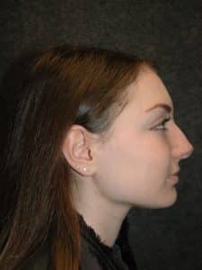 Rhinoplasty - Patient - Lateral Right - Before