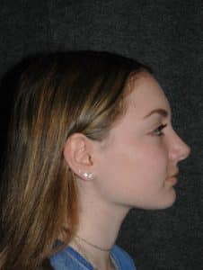 Rhinoplasty - Patient - Lateral Right - After