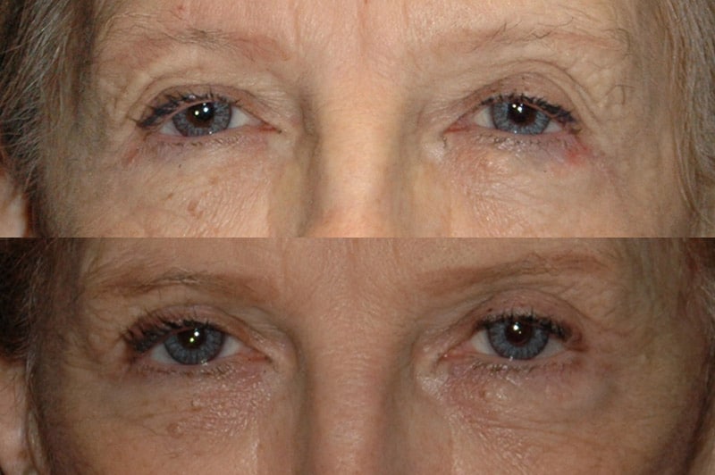 Upper Blepharoplasty Before and After Photos