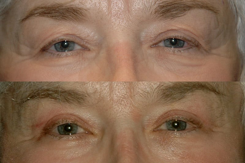 Upper Eyelid Before and After Photos