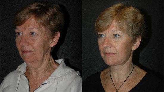 Deep Plane Facelift Before and After