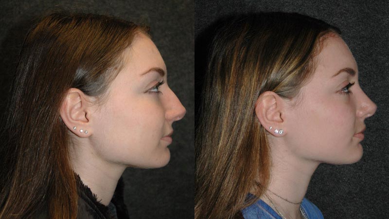 Best Rhinoplasty - Before and After Side View