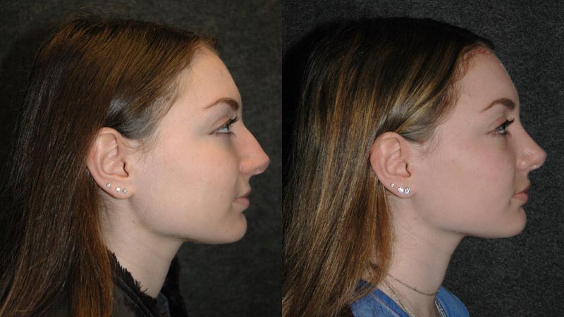 Best Rhinoplasty - Before and After Side View