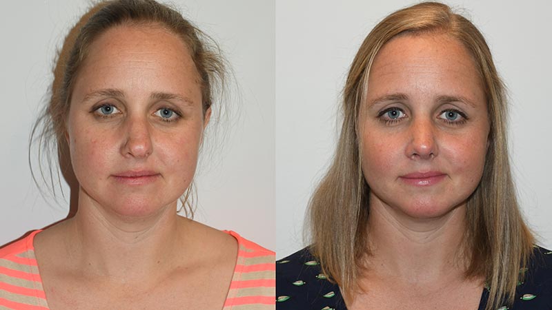 Rhinoplasty - Before and After