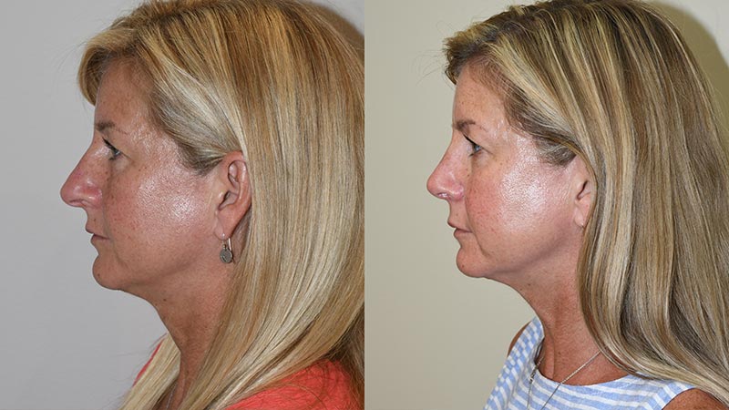 Rhinoplasty - Before and After