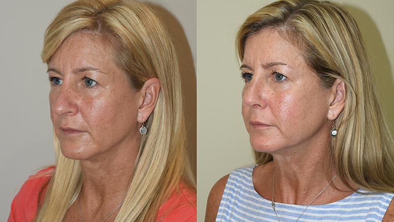 Rhinoplasty - Before and After