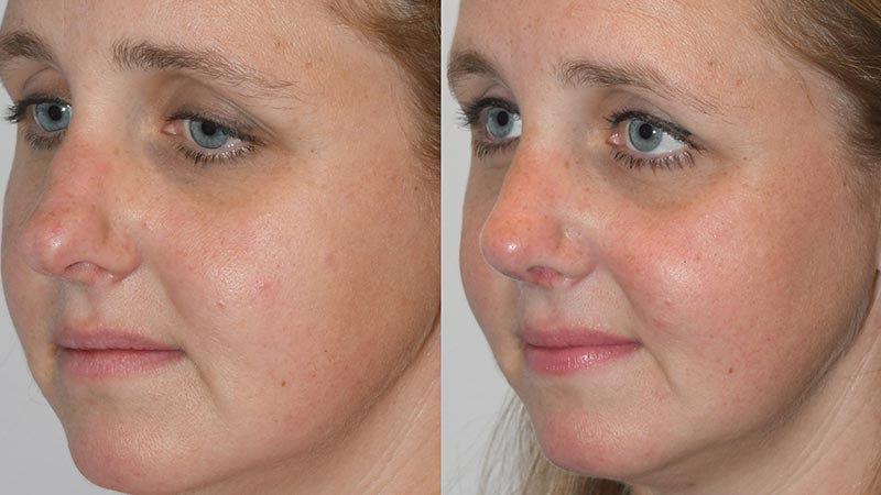 Rhinoplasty - Before and After