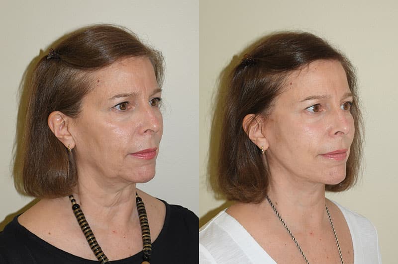 Deep Plane Facelift Before and After