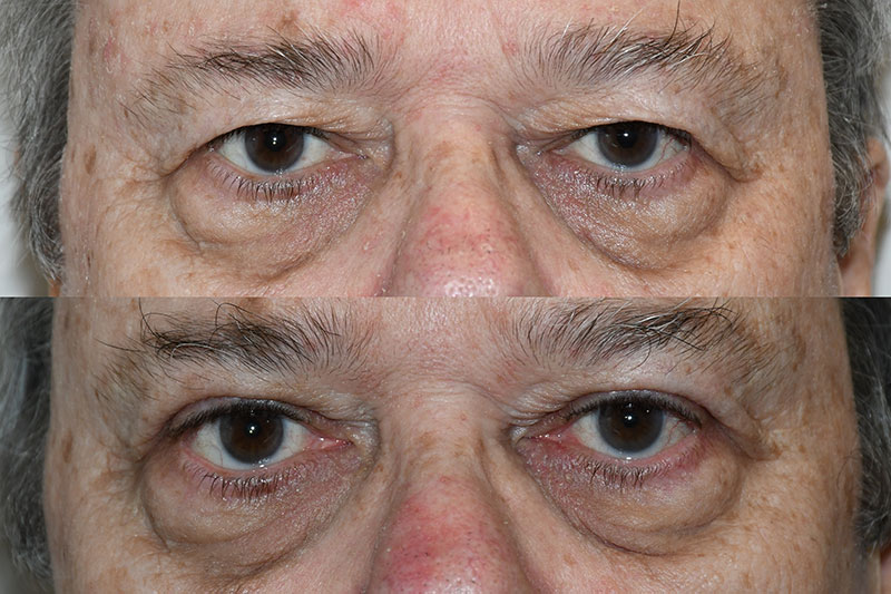 Upper Eyelid - Patient - Before and After