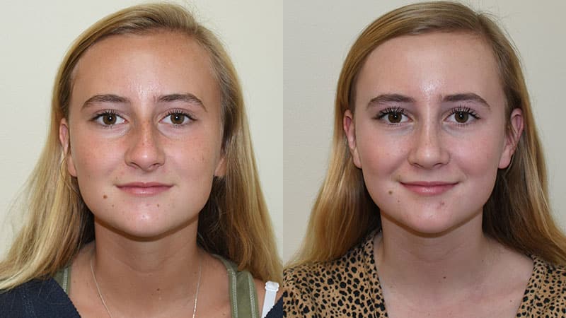 rhinoplasty before and after photos