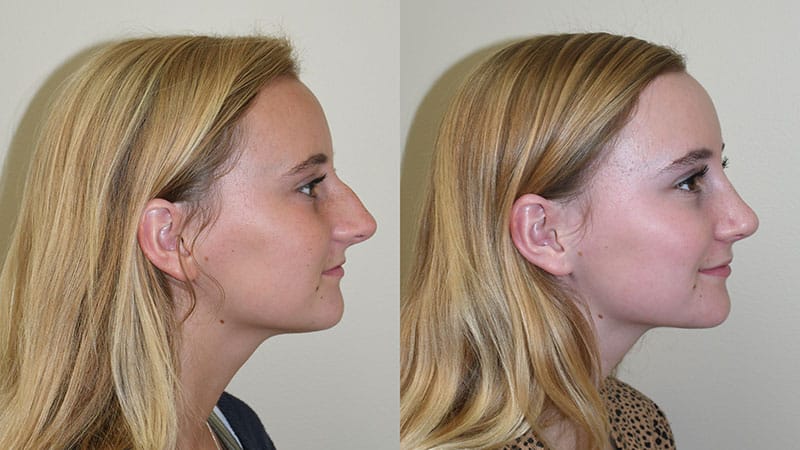 rhinoplasty before and after photos