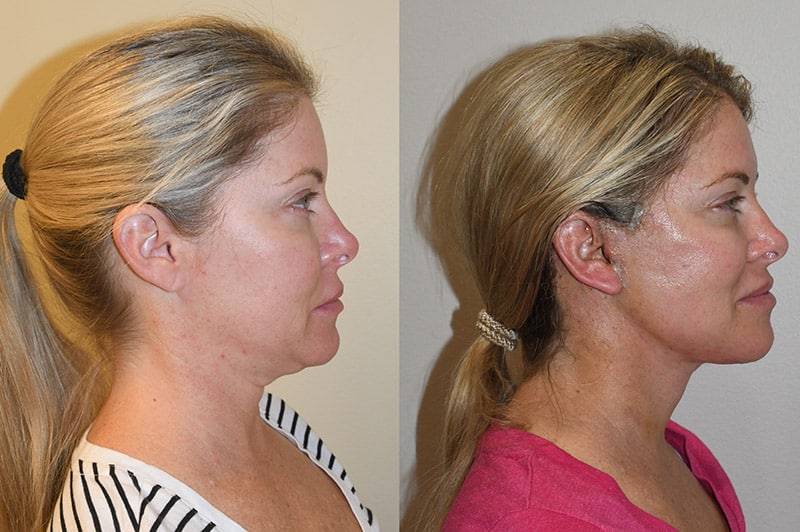 Facelift Recovery Guide