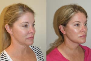 Deep Plane Facelift Before & After Photos
