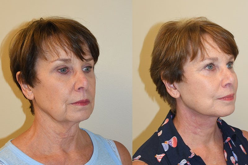 Facelift, Revision Facelift – Charleston Facial Plastic Surgery - SC