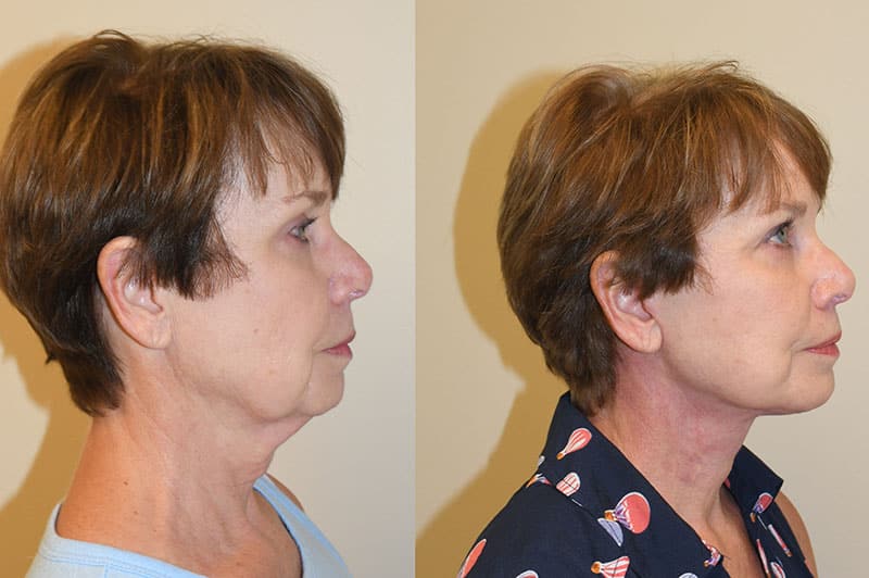 deep plane facelift results Charleston SC