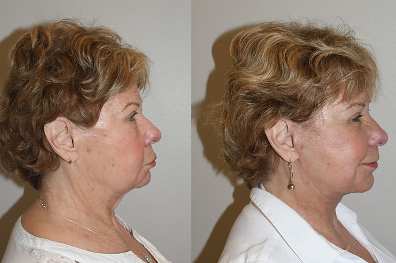 Best Revision Facelift Charleston SC