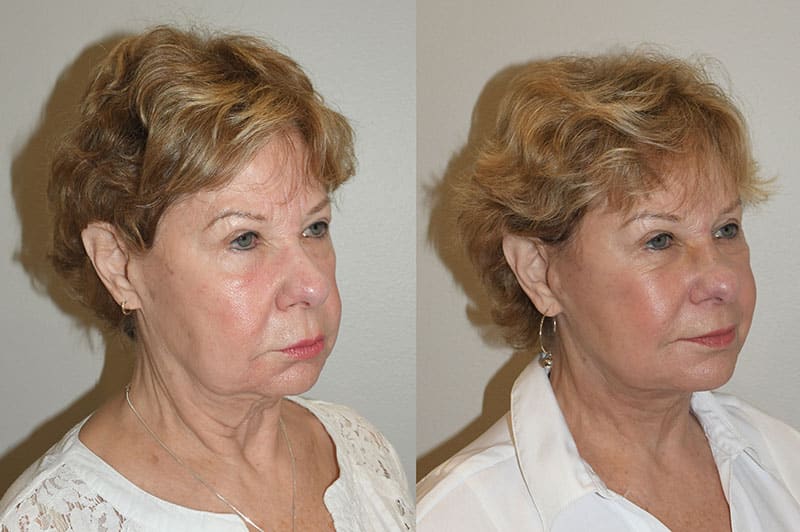Revision Facelift Before and After Patient Photos