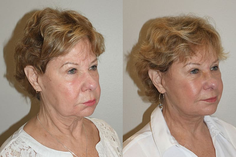 Revision Facelift Surgery  Secondary Facelift Procedures in SC