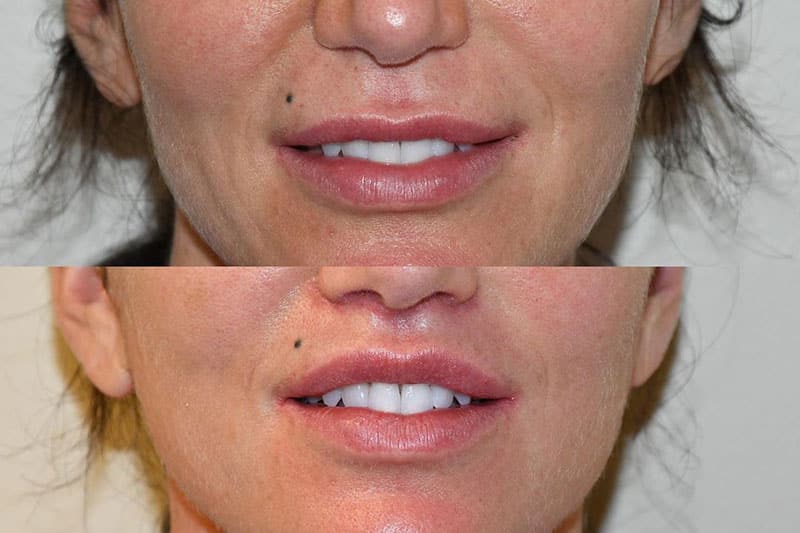 Best Lip Lift Before and After Results