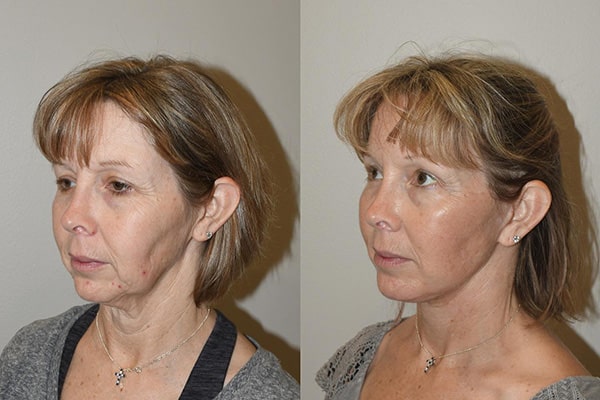 Best Neck Lift Charleston SC