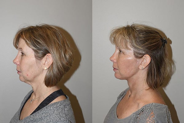 Best Neck Lift Results Charleston