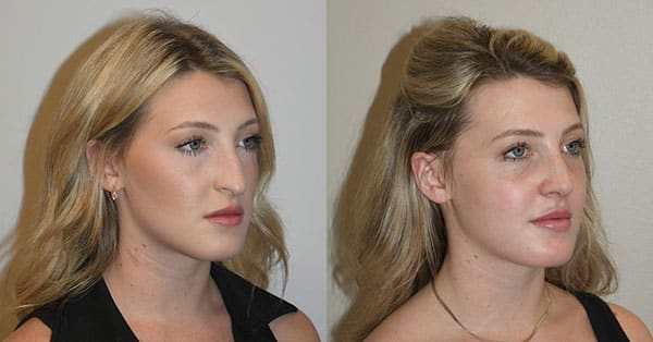 Best Open Rhinoplasty Charleston SC