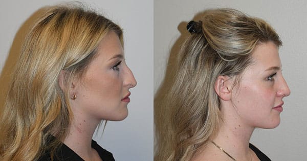 Best Open Rhinoplasty Charleston