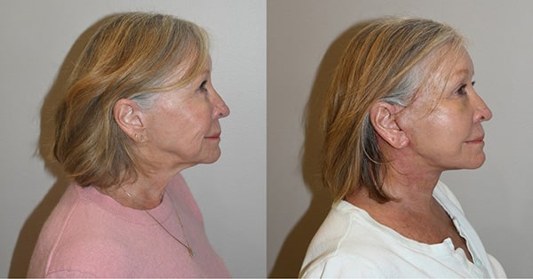 Cheek Augmentation Before and After Photos Side View
